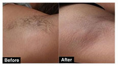 Underarm hair removal