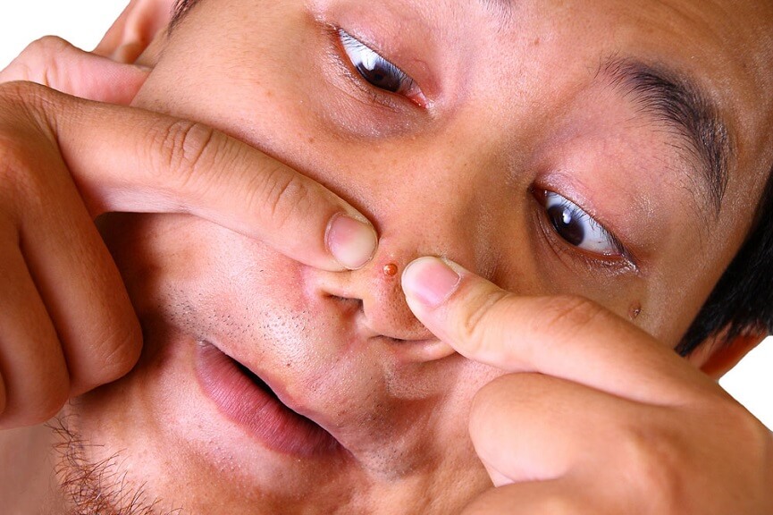 Man popping his nose acne